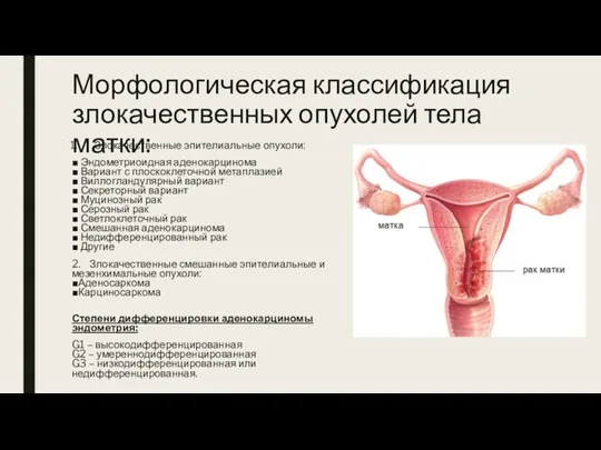 Морфологическая классификация злокачественных опухолей тела матки: Злокачественные эпителиальные опухоли: ■