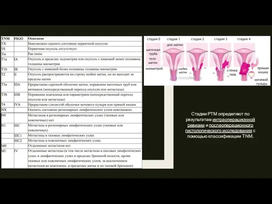 Стадии РТМ определяют по результатам интраоперационной ревизии и послеоперационного гистологического исследования с помощью классификации TNM.