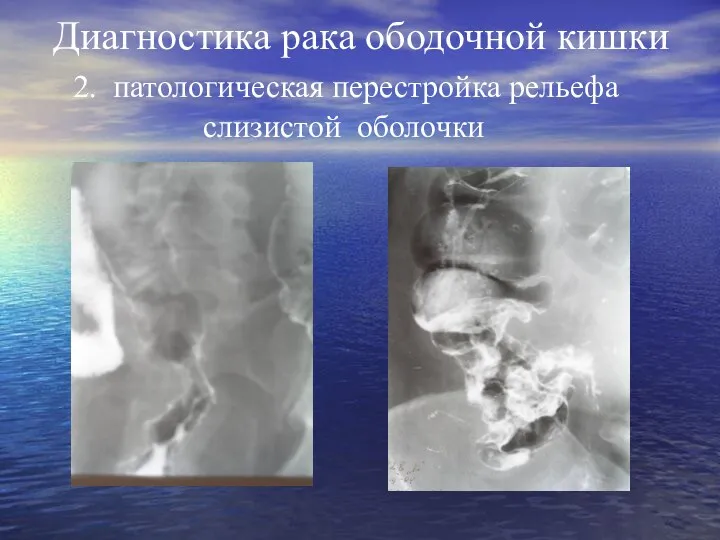 Диагностика рака ободочной кишки 2. патологическая перестройка рельефа слизистой оболочки