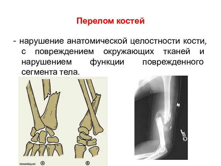 Перелом костей - нарушение анатомической целостности кости, с повреждением окружающих