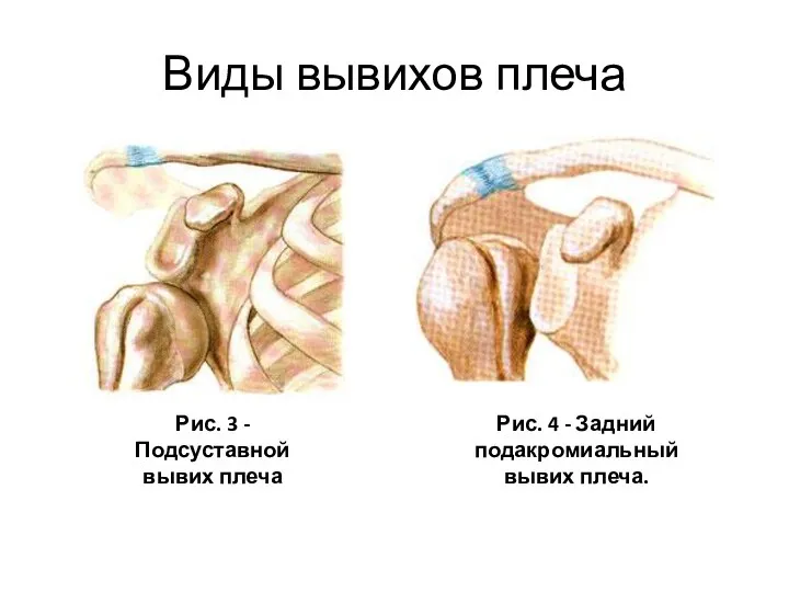 Виды вывихов плеча Рис. 3 - Подсуставной вывих плеча Рис. 4 - Задний подакромиальный вывих плеча.