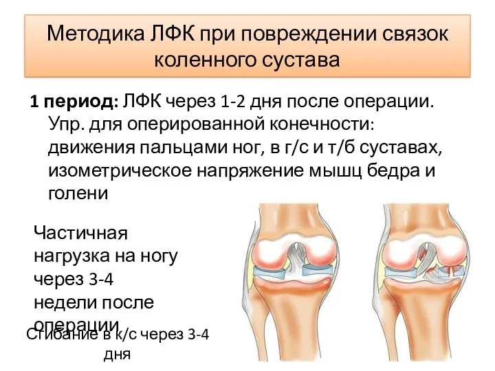 Методика ЛФК при повреждении связок коленного сустава 1 период: ЛФК