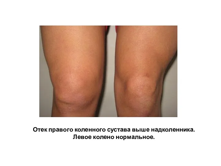 Отек правого коленного сустава выше надколенника. Левое колено нормальное.