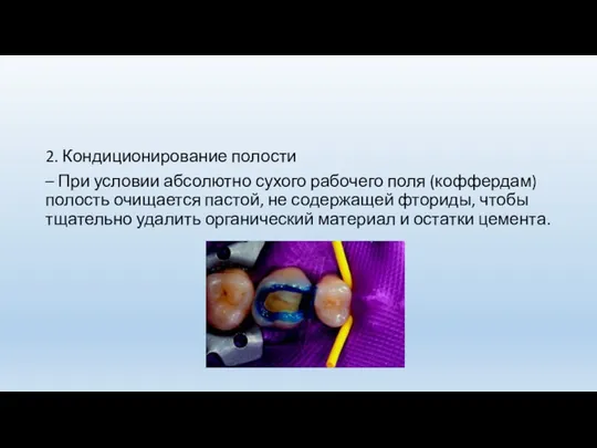 2. Кондиционирование полости – При условии абсолютно сухого рабочего поля (коффердам) полость очищается