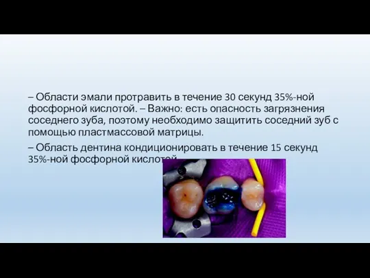 – Области эмали протравить в течение 30 секунд 35%-ной фосфорной кислотой. – Важно: