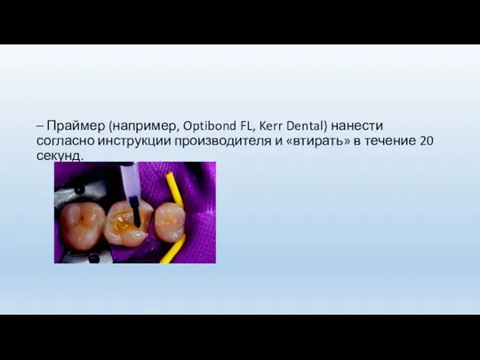 – Праймер (например, Optibond FL, Kerr Dental) нанести согласно инструкции производителя и «втирать»