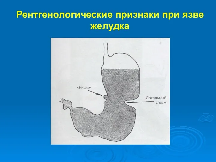 Рентгенологические признаки при язве желудка