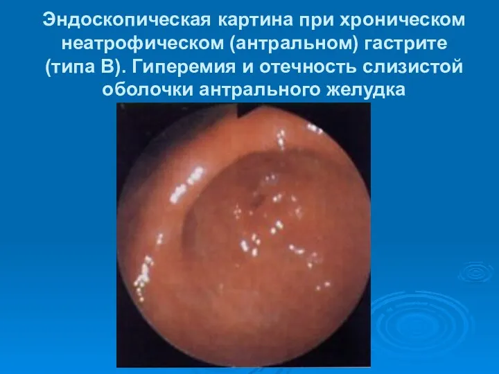 Эндоскопическая картина при хроническом неатрофическом (антральном) гастрите (типа В). Гиперемия и отечность слизистой оболочки антрального желудка