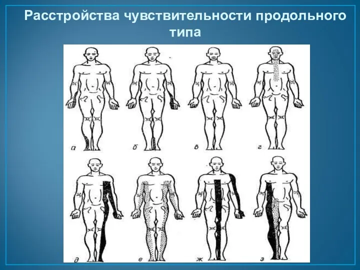 Расстройства чувствительности продольного типа