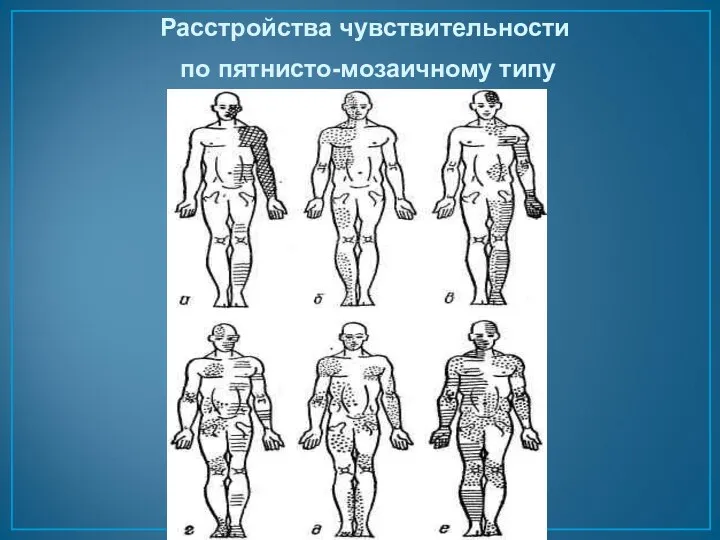 Расстройства чувствительности по пятнисто-мозаичному типу