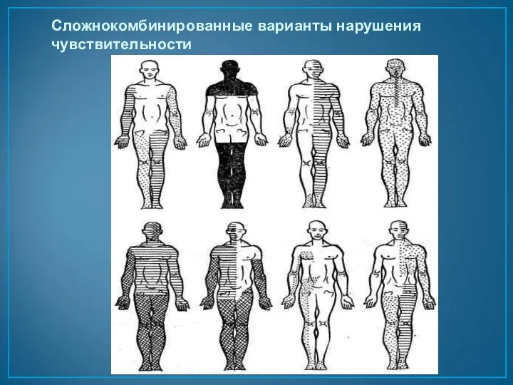 Сложнокомбинированные варианты нарушения чувствительности