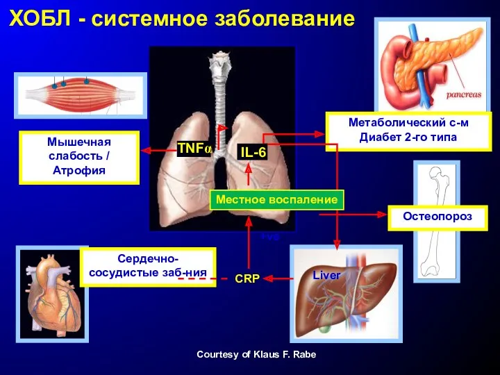 Mышечная слабость / Атрофия Mетаболический с-м Диабет 2-го типа Остеопороз CRP Сердечно-сосудистые заб-ния