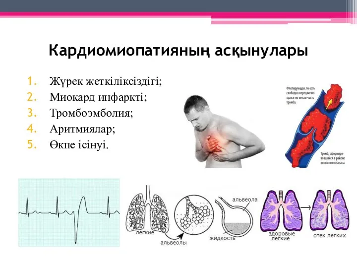 Кардиомиопатияның асқынулары Жүрек жеткіліксіздігі; Миокард инфаркті; Тромбоэмболия; Аритмиялар; Өкпе ісінуі.