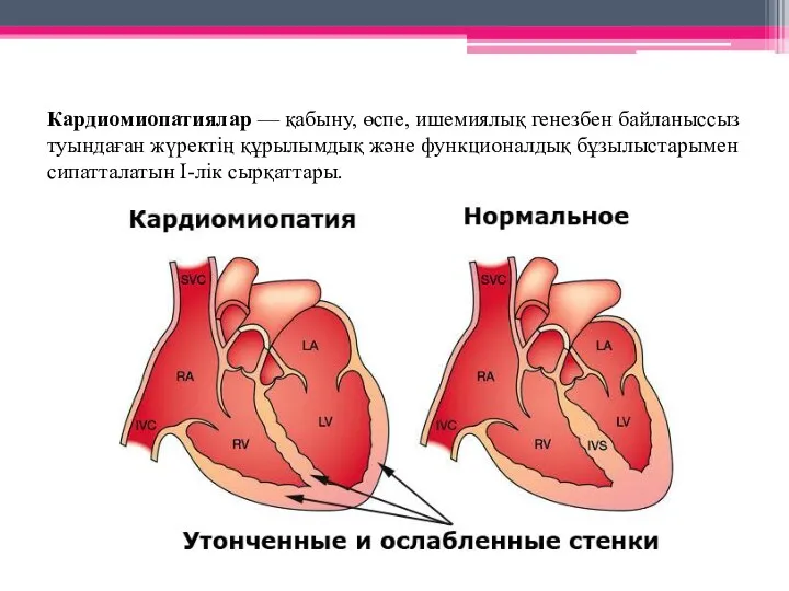 Кардиомиопатиялар — қабыну, өспе, ишемиялық генезбен байланыссыз туындаған жүректің құрылымдық және функционалдық бұзылыстарымен сипатталатын І-лік сырқаттары.