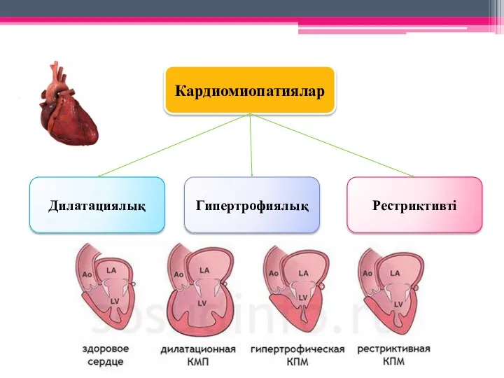 Кардиомиопатиялар Дилатациялық Рестриктивті Гипертрофиялық