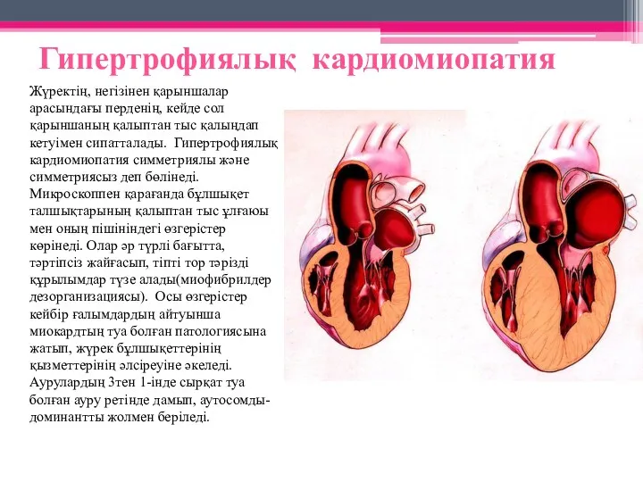 Гипертрофиялық кардиомиопатия Жүректің, негізінен қарыншалар арасындағы перденің, кейде сол қарыншаның