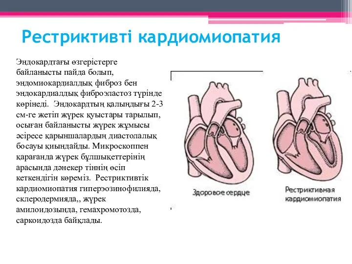 Рестриктивті кардиомиопатия Эндокардтағы өзгерістерге байланысты пайда болып, эндомиокардиалдық фиброз бен эндокардиалдық фиброэластоз түрінде