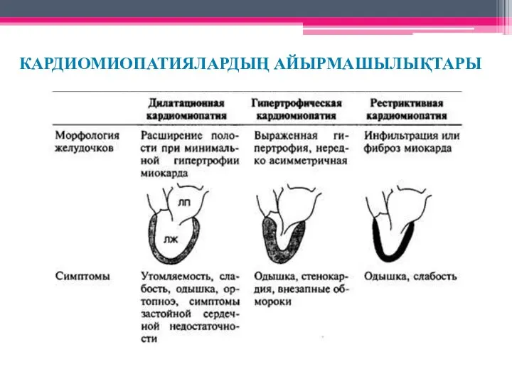 КАРДИОМИОПАТИЯЛАРДЫҢ АЙЫРМАШЫЛЫҚТАРЫ