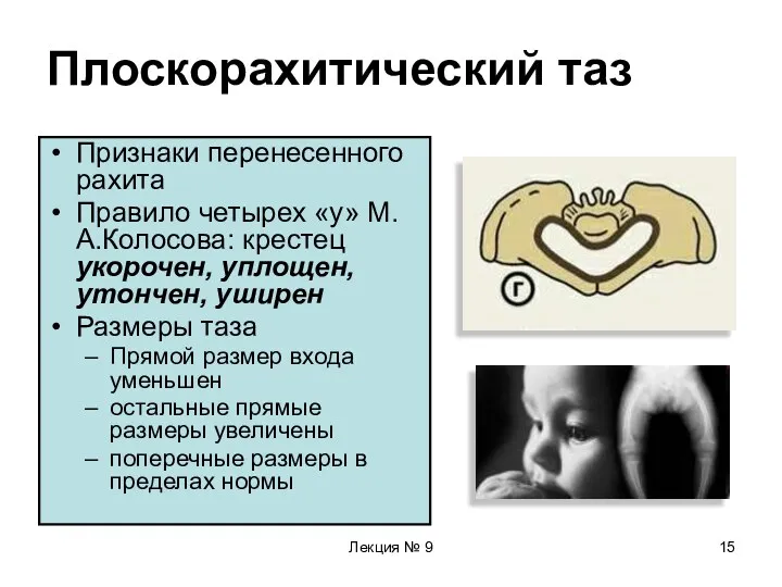 Лекция № 9 Плоскорахитический таз Признаки перенесенного рахита Правило четырех