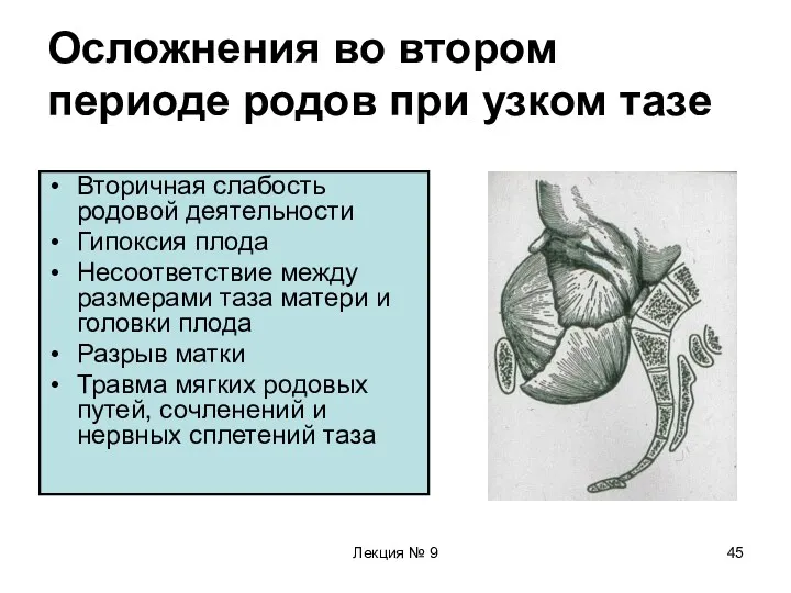 Лекция № 9 Осложнения во втором периоде родов при узком тазе Вторичная слабость