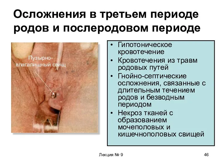 Лекция № 9 Осложнения в третьем периоде родов и послеродовом периоде Гипотоническое кровотечение