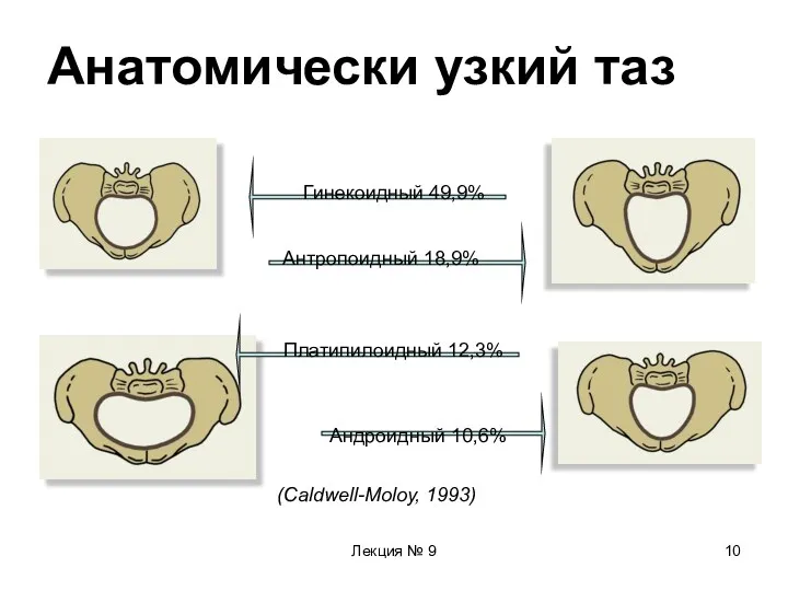 Лекция № 9 Анатомически узкий таз Гинекоидный 49,9% Антропоидный 18,9% (Caldwell-Moloy, 1993)