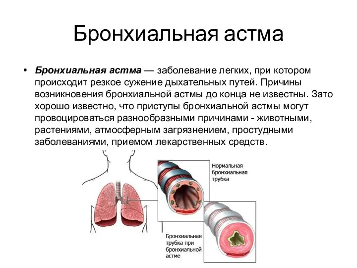 Бронхиальная астма Бронхиальная астма — заболевание легких, при котором происходит