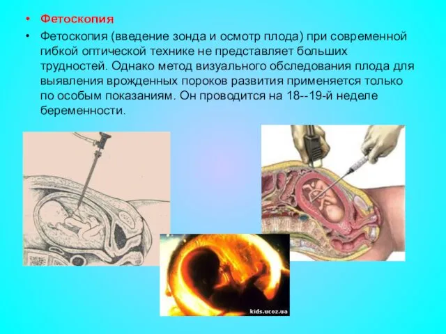 Фетоскопия Фетоскопия (введение зонда и осмотр плода) при современной гибкой