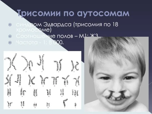 Трисомии по аутосомам синдром Эдвардса (трисомия по 18 хромосоме) Соотношение