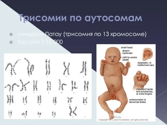 Трисомии по аутосомам синдром Патау (трисомия по 13 хромосоме) Частота 1:10 000
