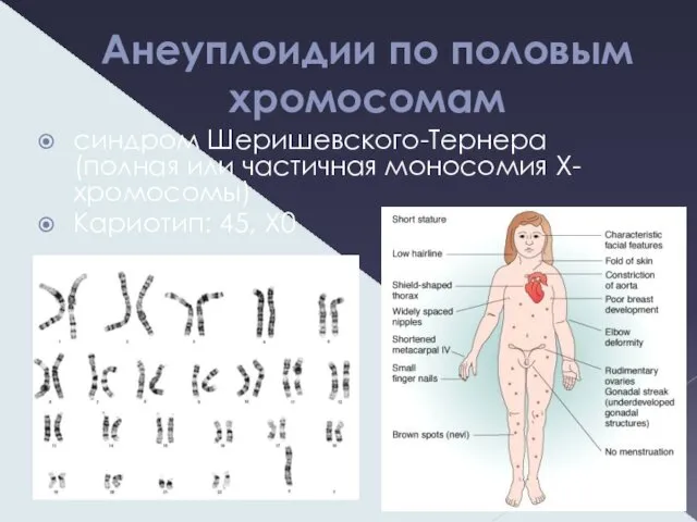 Анеуплоидии по половым хромосомам синдром Шеришевского-Тернера (полная или частичная моносомия X-хромосомы) Кариотип: 45, X0