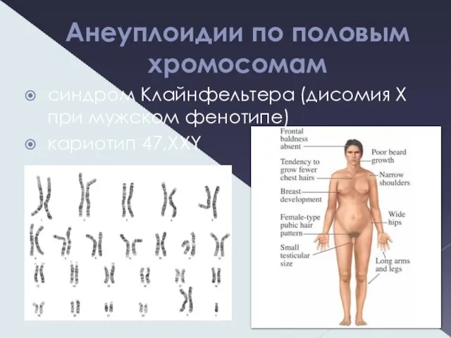 Анеуплоидии по половым хромосомам синдром Клайнфельтера (дисомия Х при мужском фенотипе) кариотип 47,XXY