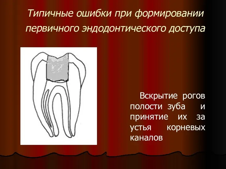 Типичные ошибки при формировании первичного эндодонтического доступа Вскрытие рогов полости