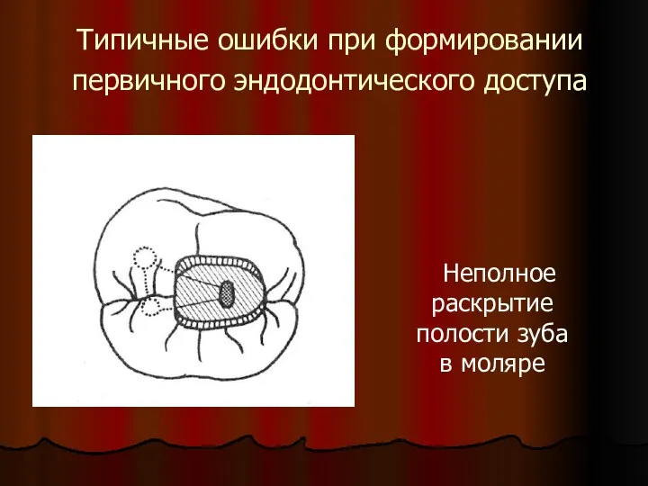 Типичные ошибки при формировании первичного эндодонтического доступа Неполное раскрытие полости зуба в моляре