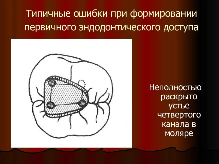 Типичные ошибки при формировании первичного эндодонтического доступа Неполностью раскрыто устье четвертого канала в моляре