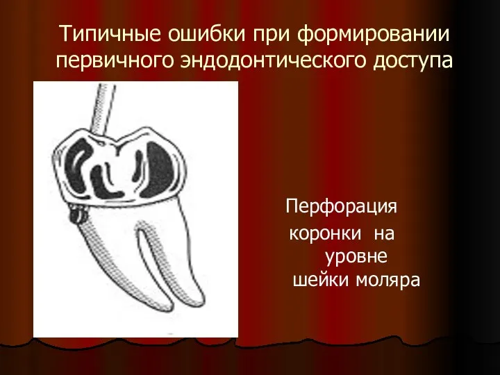 Типичные ошибки при формировании первичного эндодонтического доступа Перфорация коронки на уровне шейки моляра