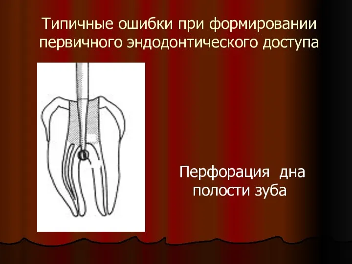 Типичные ошибки при формировании первичного эндодонтического доступа Перфорация дна полости зуба