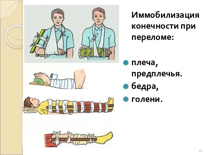 Иммобилизация конечности при переломе: плеча, предплечья. бедра, голени.