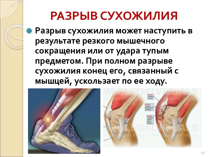 РАЗРЫВ СУХОЖИЛИЯ Разрыв сухожилия может наступить в результате резкого мышечного