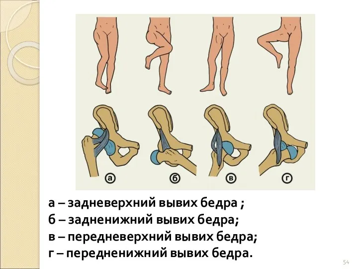 а – задневерхний вывих бедра ; б – задненижний вывих