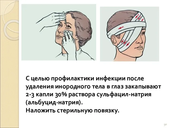 С целью профилактики инфекции после удаления инородного тела в глаз