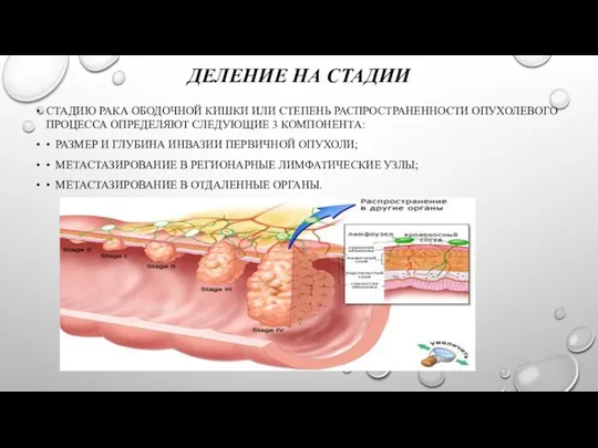 ДЕЛЕНИЕ НА СТАДИИ СТАДИЮ РАКА ОБОДОЧНОЙ КИШКИ ИЛИ СТЕПЕНЬ РАСПРОСТРАНЕННОСТИ