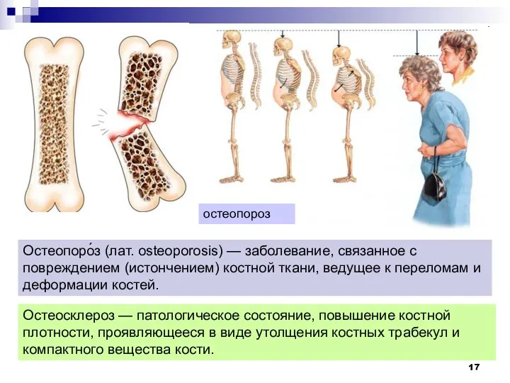 остеопороз Остеосклероз — патологическое состояние, повышение костной плотности, проявляющееся в виде утолщения костных