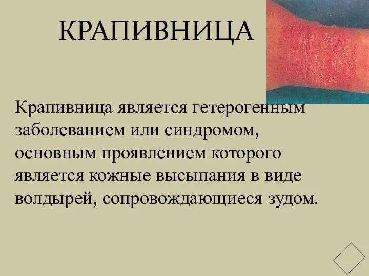 КРАПИВНИЦА Крапивница является гетерогенным заболеванием или синдромом, основным проявлением которого является кожные высыпания