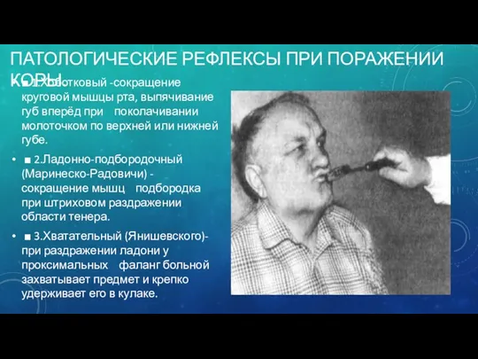 ПАТОЛОГИЧЕСКИЕ РЕФЛЕКСЫ ПРИ ПОРАЖЕНИИ КОРЫ. ■ 1.Хоботковый -сокращение круговой мышцы