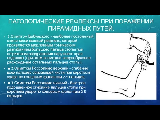 ПАТОЛОГИЧЕСКИЕ РЕФЛЕКСЫ ПРИ ПОРАЖЕНИИ ПИРАМИДНЫХ ПУТЕЙ. 1.Симптом Бабинского - наиболее