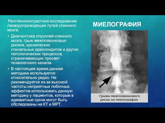 МИЕЛОГРАФИЯ Рентгеноконтрастное исследование ликворопроводящих путей спинного мозга. Диагностика опухолей спинного