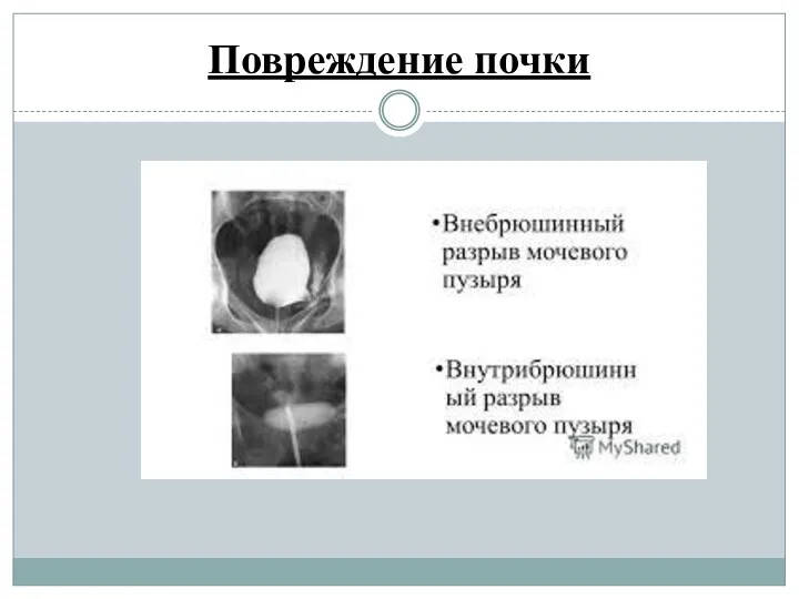 Повреждение почки