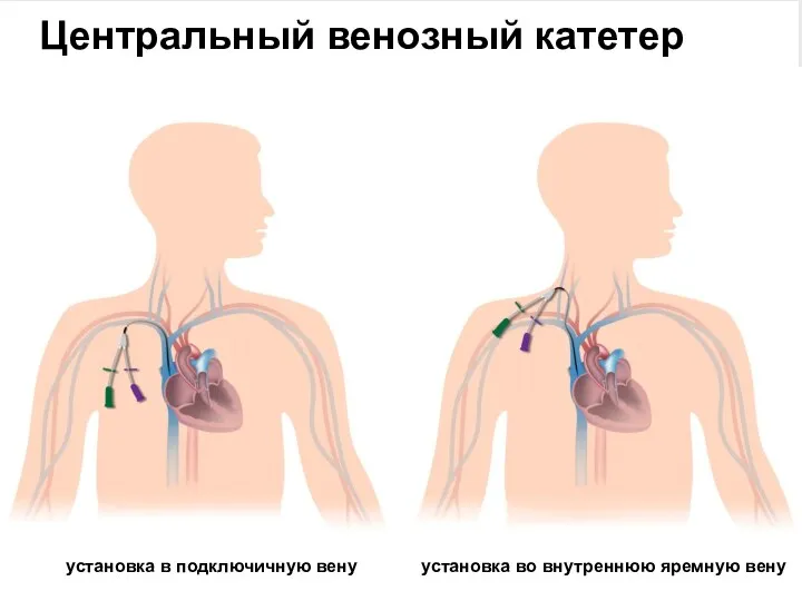 Центральный венозный катетер установка в подключичную вену установка во внутреннюю яремную вену