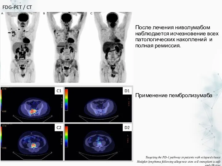 После лечения ниволумабом наблюдается исчезновение всех патологических накоплений и полная ремиссия. FDG-PET /